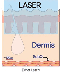 other laser 이미지입니다.