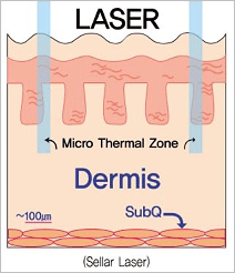 sellar laser 이미지입니다.