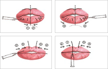 아랫입술, 윗입술 부위별 필러 주사위치 안내 이미지입니다.