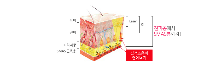 집적초음파 열에너지가 발생되는 사진